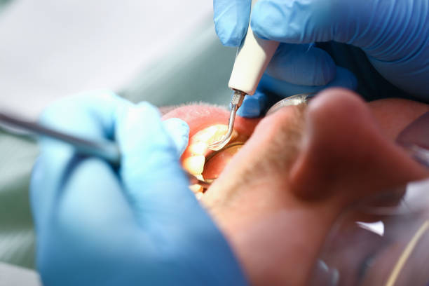 Best Emergency Treatment for Dental Infections or Abscesses in Woodfield, SC